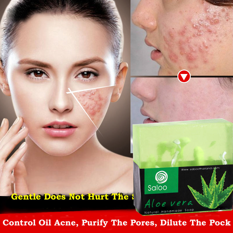 Aloe vera handmade soap for acne control showing improvement in skin texture with use, featuring herbal fragrance and moisturizing benefits.
