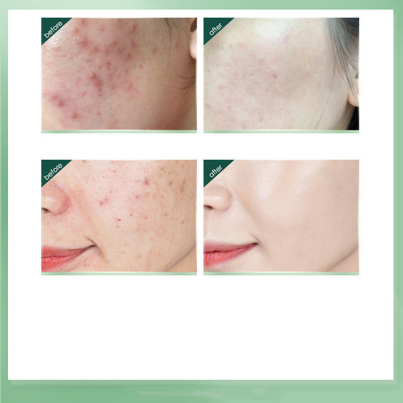 Tea Tree Acne Removing Cream Firming Elastic Moisturizing Oil Control