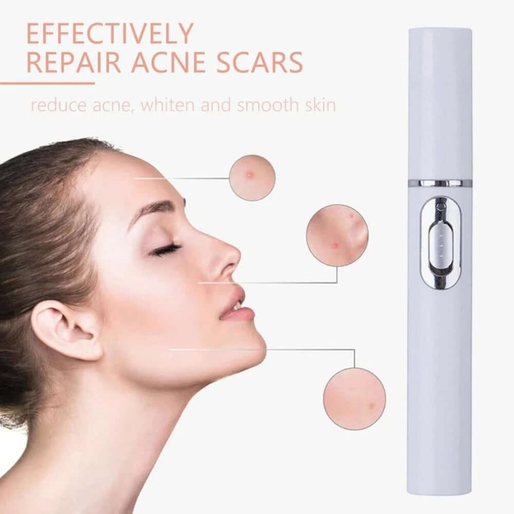 "Blue Light Therapy Acne Laser Pen - Soft Scar and Wrinkle Removal Treatment Device for Skin Care and Beauty"