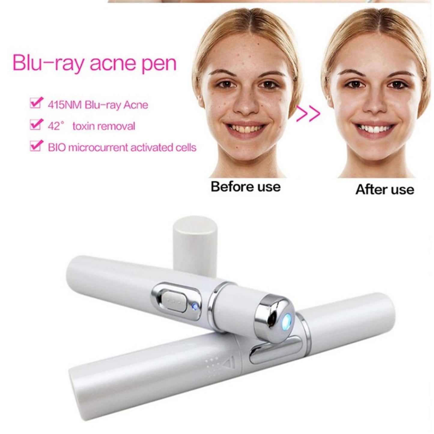 "Blue Light Therapy Acne Laser Pen - Soft Scar and Wrinkle Removal Treatment Device for Skin Care and Beauty"