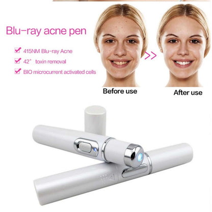 "Blue Light Therapy Acne Laser Pen - Soft Scar and Wrinkle Removal Treatment Device for Skin Care and Beauty"