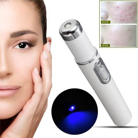 "Blue Light Therapy Acne Laser Pen - Soft Scar and Wrinkle Removal Treatment Device for Skin Care and Beauty"