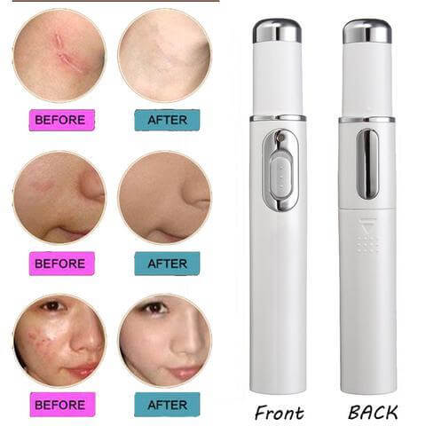 "Blue Light Therapy Acne Laser Pen - Soft Scar and Wrinkle Removal Treatment Device for Skin Care and Beauty"