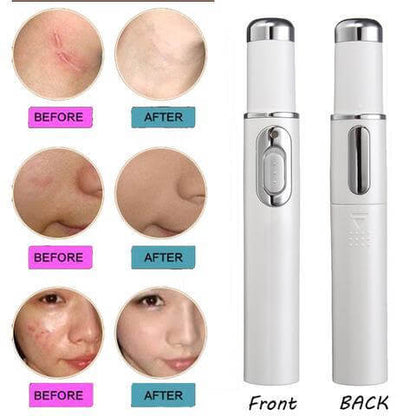 "Blue Light Therapy Acne Laser Pen - Soft Scar and Wrinkle Removal Treatment Device for Skin Care and Beauty"