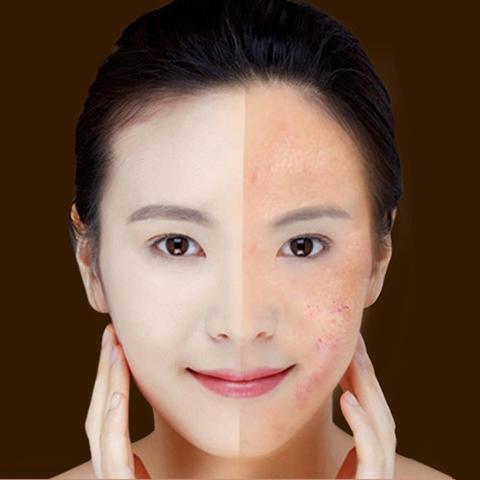 "Blue Light Therapy Acne Laser Pen - Soft Scar and Wrinkle Removal Treatment Device for Skin Care and Beauty"